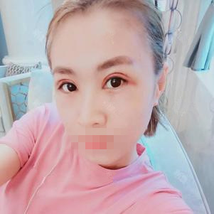 广州军美整形王世虎双眼皮手术,拥有迷人电眼