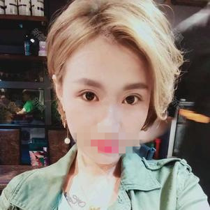 广州军美整形王世虎双眼皮手术,拥有迷人电眼