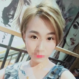 广州军美整形王世虎双眼皮手术,拥有迷人电眼