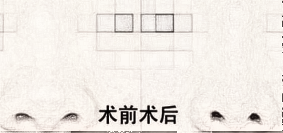 鼻骨内推真的适合什么样的人?