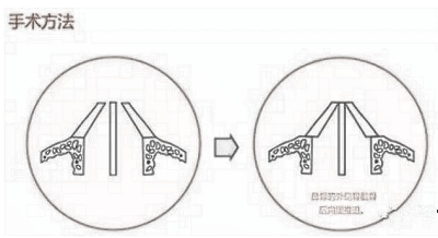 鼻骨内推真的适合什么样的人?