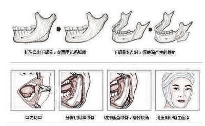 做面部轮廓都有哪些人?哪里做比较好?