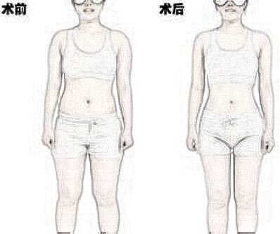 术前术后 整形手术术前术后注意事项