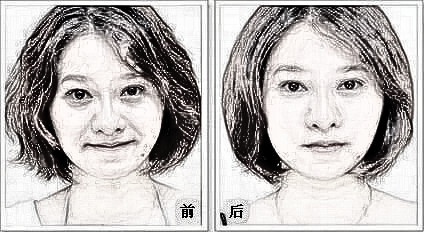 热玛吉除皱的有关知识。