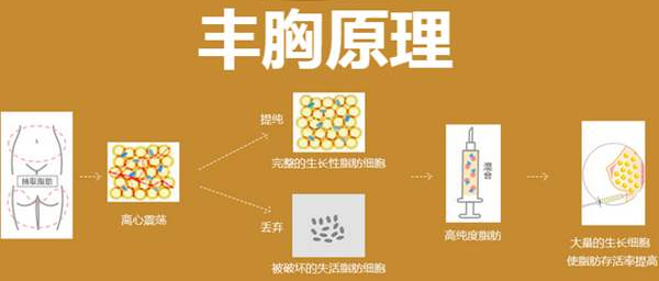 自体脂肪隆胸你真的了解吗?