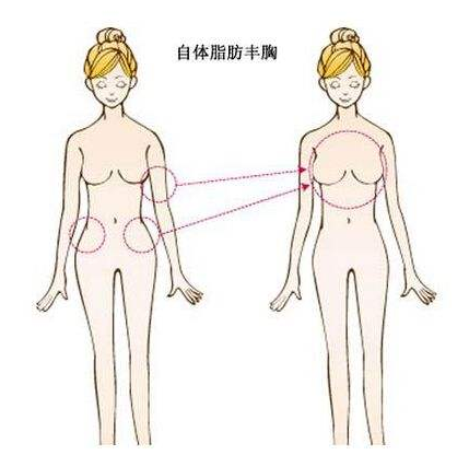 自体脂肪隆胸你真的了解吗?