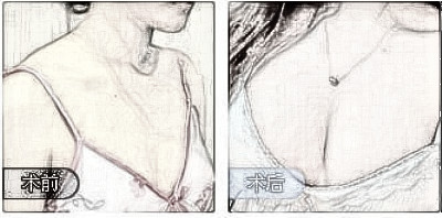 重庆爱美者自体脂肪隆胸术后3月分享付图！