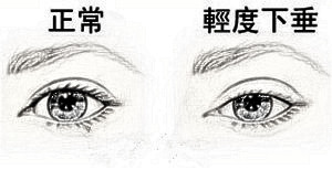 双眼皮手术会不会影响双眼视力?