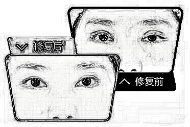 中山韩华整形医院双眼皮修复手术的特点 有风险吗