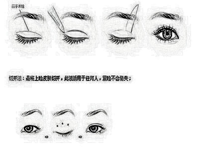 埋线双眼皮后能保持多久啊