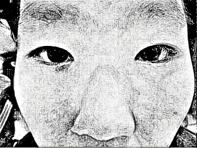 李春生专家做颧骨整形手术有介绍吗?做的怎样