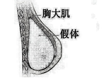 石家庄星源整形医院乳房再造有哪些优点