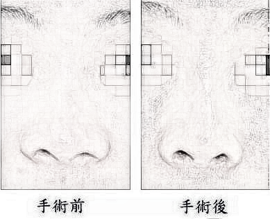 鼻头缩小术 摆脱大鼻头的尴尬