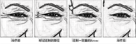 广西南宁梦想川字纹去除方法有哪些