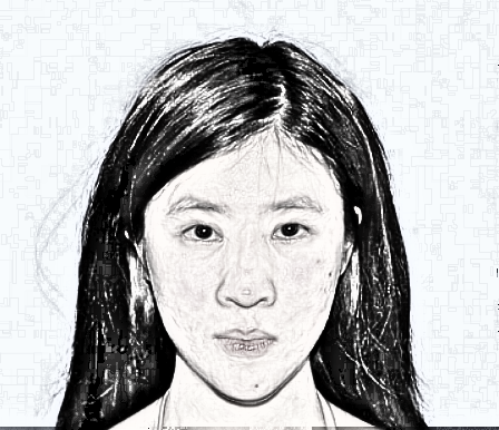 北医三院闫爱萍全切双眼皮 术后60天果恢复分享