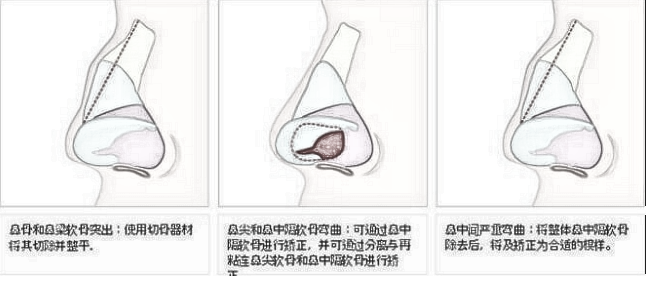 北京新极点歪鼻矫正适应于怎样的鼻子