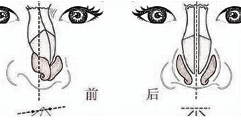 北京新极点歪鼻矫正适应于怎样的鼻子