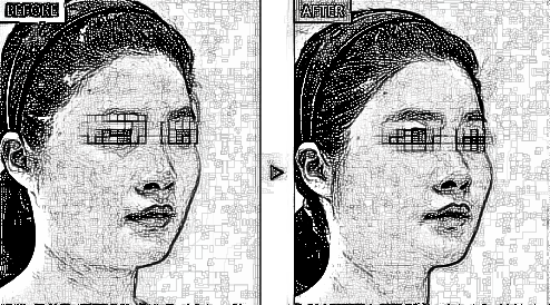 额头凹陷不好看 选择没问题方便的假体丰额头