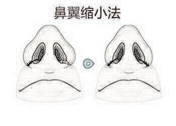 北京鼻翼缩小整形多少钱