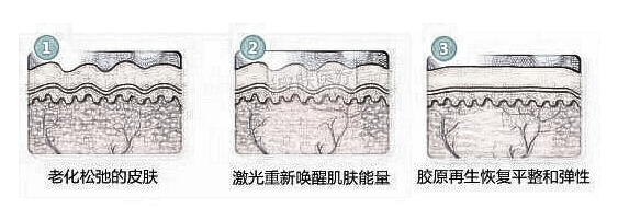 去除鱼尾纹 放心大笑的秘密