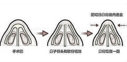 重庆整容医院排名 鹰钩鼻矫正没问题吗
