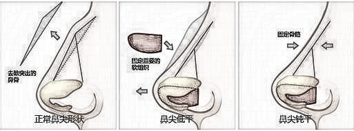 重庆整容医院排名 鹰钩鼻矫正没问题吗