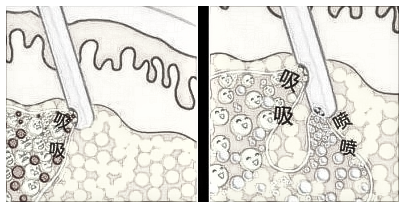 image.png 水动力和360吸脂的区别?