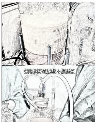 image.png 水动力和360吸脂的区别?
