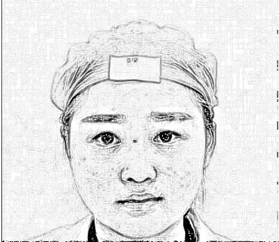 北京八大处刘珍君做的双眼皮怎么样?术后图实拍图参考