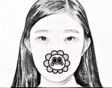 上海美联臣安承贤割双眼皮好吗?恢复一览