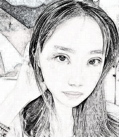 成都美立方医院找张娟做的眼部手术怎么样?恢复一览