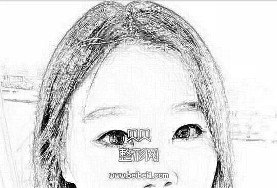 深圳阳光双眼皮介绍:小姐姐的整形经历分享