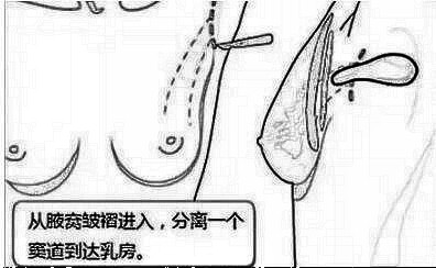 深圳南雅整形美容的姚成红简介 医生技术怎么样?,隆胸口碑分享!