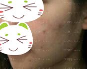 做了几次微针感觉还挺不错的,现在面部痘痘也都消失了