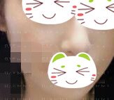 做了几次微针感觉还挺不错的,现在面部痘痘也都消失了
