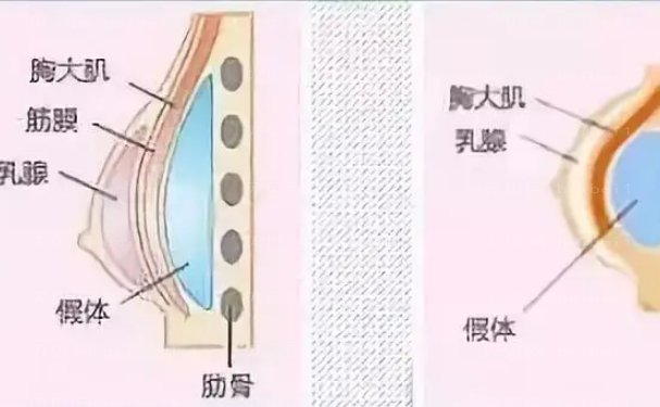 假体隆胸好的医生是谁?医生排名揭晓