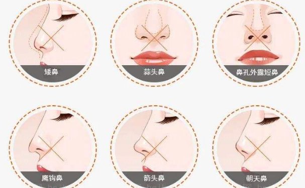 贵阳自体隆鼻介绍靠前的医生名单