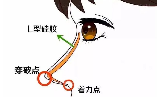 成都军大钟正强做鼻子怎么样?手术价格+整形案例