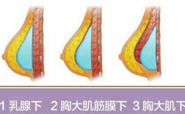 上海仁爱医院潘舒亚假体隆胸怎么样?技术评测+案例