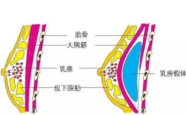 天津南开联合丽格王文凯假体隆胸怎么样?技术评价+手术案例