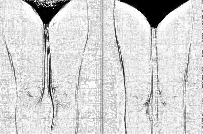 南京大腿吸脂费用需要多少?