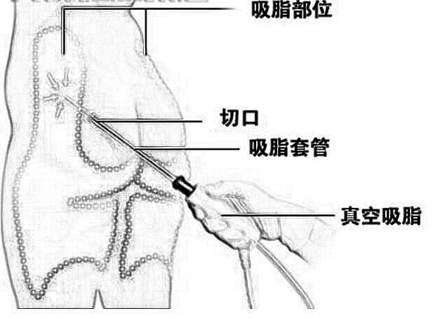 雕塑性吸脂的有关事项