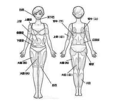 雕塑性吸脂的有关事项
