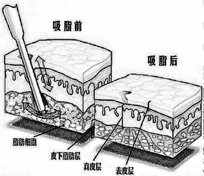 腰腹吸脂手术果怎么样呢？
