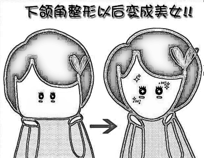 颧骨整形手术多长时间恢复果较好 多少钱