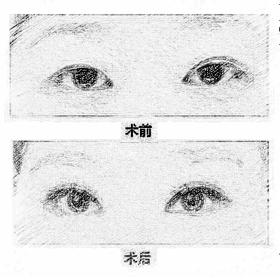 双眼皮手术失败怎么办？南京眼修复医生为你解