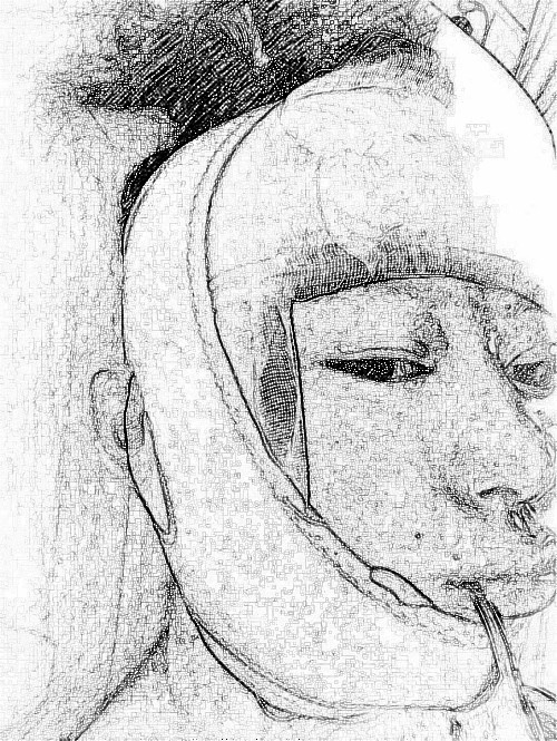 杭州华山连天美整形医院医生高俊明下颌角整形介绍!