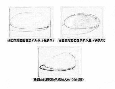 假体隆胸材料的选择！