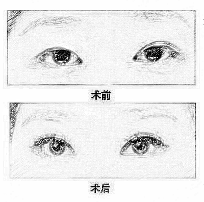 艾俪美微整形会所哪个医生做双眼皮比较好？