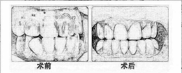 牙齿矫正修复会有后遗症吗?预防措施